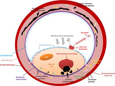 Frontiers | Histology-Verified Intracranial Artery Calcification And ...